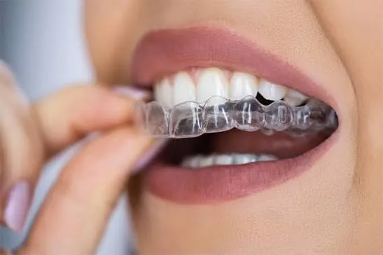 Gutieră pentru bruxism la North Dent, Râmnicu Vâlcea